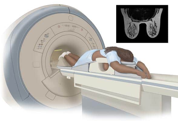 What exactly is breast cancer screening?<br />
