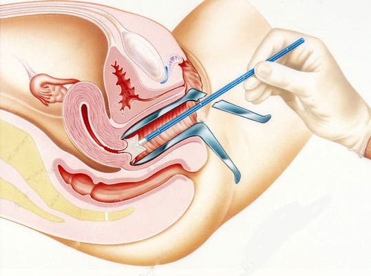 Pap smear test