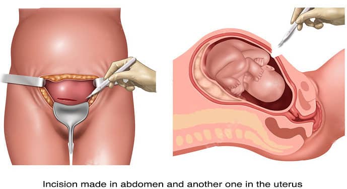 High Risk pregnancy