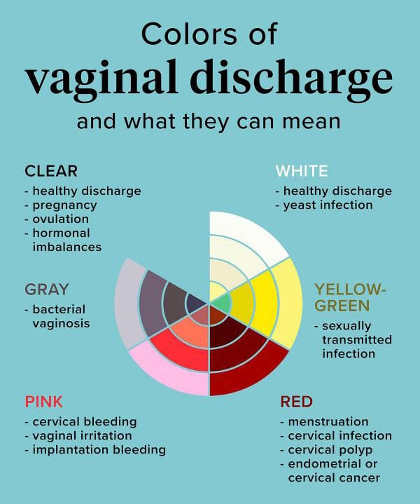 Can Endometriosis Cause Vaginal Discharge?