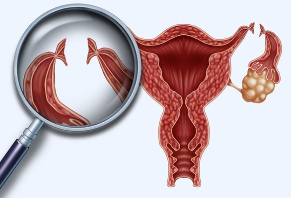 Laparoscopic Sterilization: Clinical Aspects | GLOWM