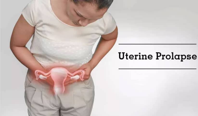 you need to know all about uterine prolapse