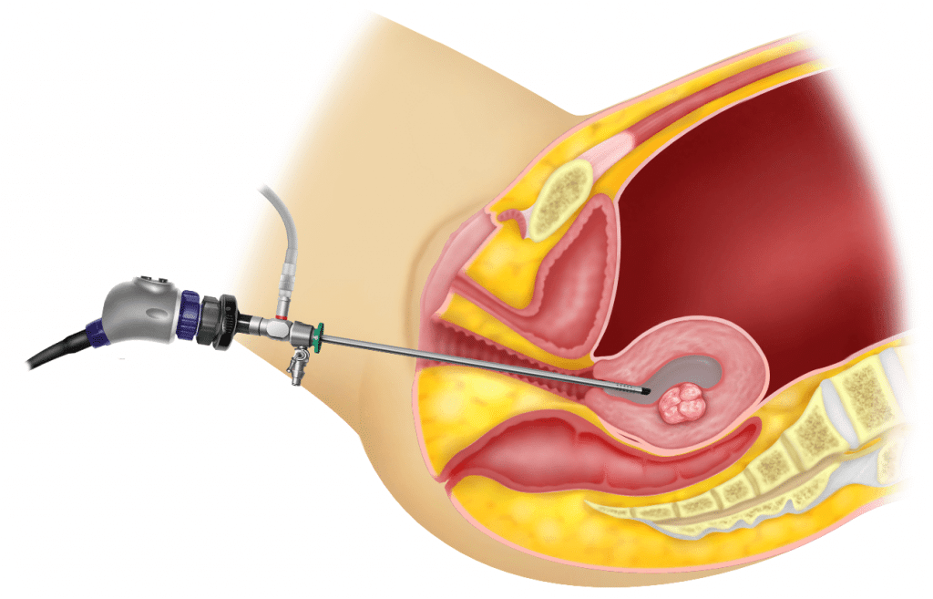 Hysteroscopy treatment in Thane 
